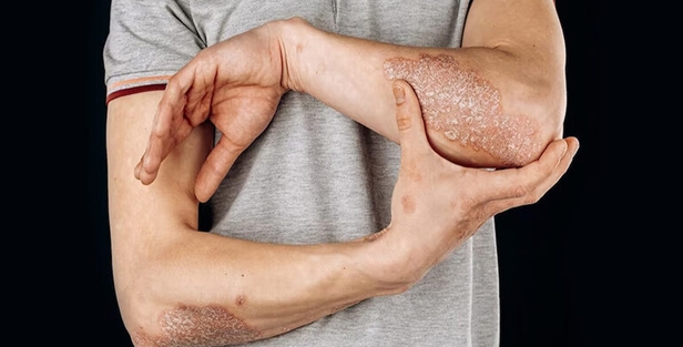 ابتلای بیش از 100 میلیون نفر در جهان به پسوریازیس 